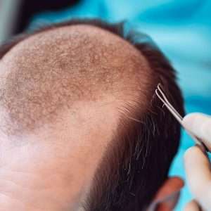 탈모 모발 이식